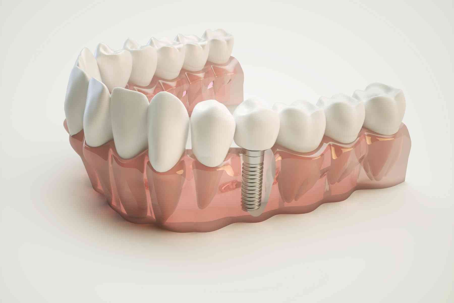 implat-tedavisi-ay-isigi-dis implant ay ışığı diş